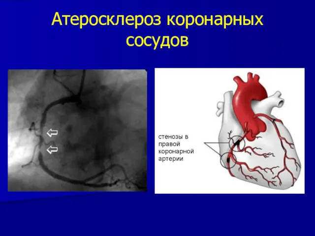 Атеросклероз коронарных сосудов