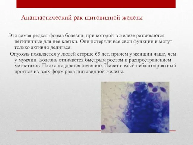 Анапластический рак щитовидной железы Это самая редкая форма болезни, при