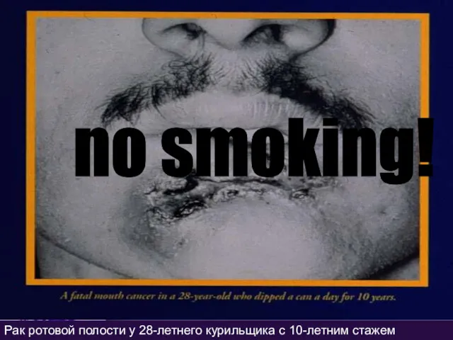 Рак ротовой полости у 28-летнего курильщика с 10-летним стажем no smoking!