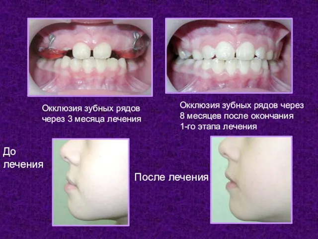 Окклюзия зубных рядов через 3 месяца лечения. Окклюзия зубных рядов