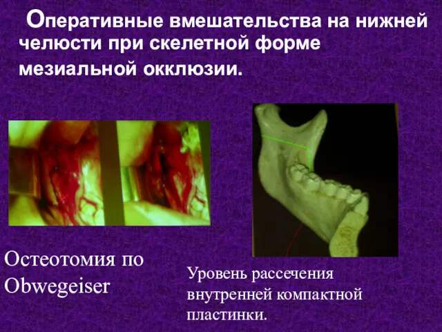 Оперативные вмешательства на нижней челюсти при скелетной форме мезиальной окклюзии.