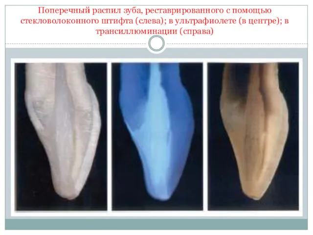 Поперечный распил зуба, реставрированного с помощью стекловолоконного штифта (слева); в ультрафиолете (в центре); в трансиллюминации (справа)