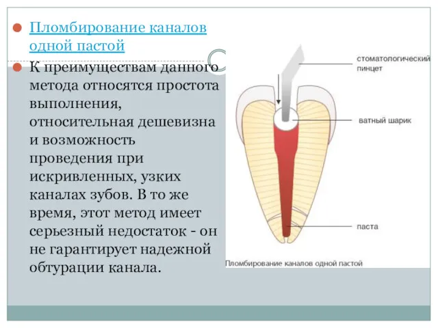 Пломбирование каналов одной пастой К преимуществам данного метода относятся простота