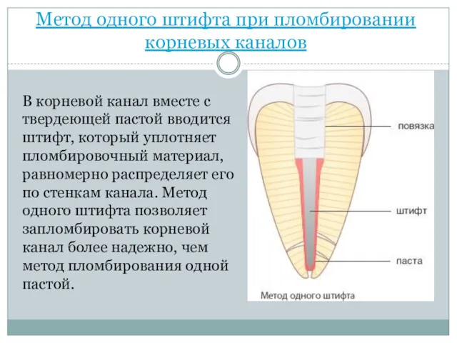 Метод одного штифта при пломбировании корневых каналов В корневой канал