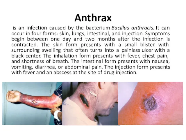 Anthrax is an infection caused by the bacterium Bacillus anthracis.