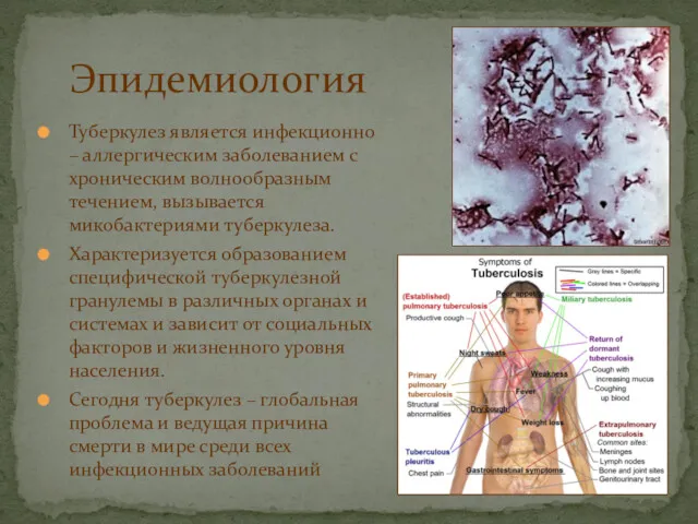 Эпидемиология Туберкулез является инфекционно – аллергическим заболеванием с хроническим волнообразным