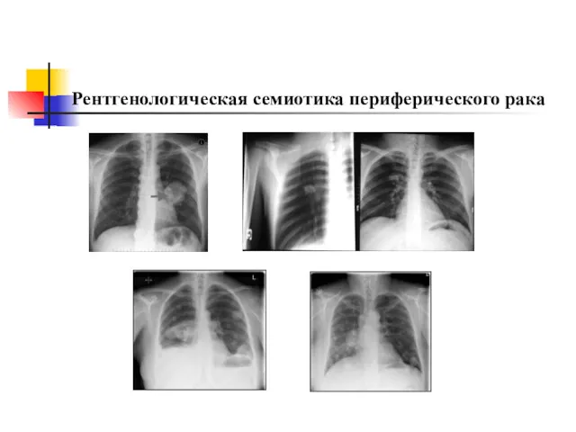 Рентгенологическая семиотика периферического рака