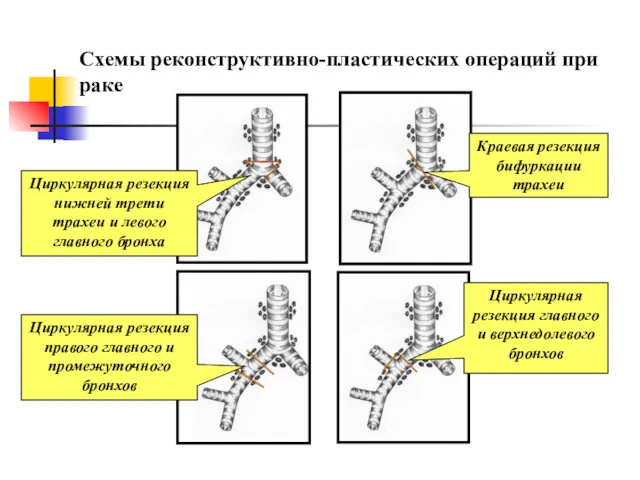 Схемы реконструктивно-пластических операций при раке Циркулярная резекция нижней трети трахеи и левого главного