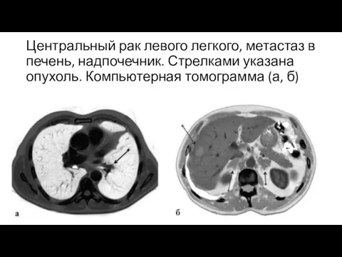 Центральный рак левого легкого, метастаз в печень, надпочечник. Стрелками указана опухоль. Компьютерная томограмма (а, б)