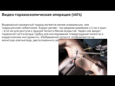 Видео-торакоскопическая операция (VATS) Видеоассистированный подход является менее инвазивным, чем традиционная лобэктомия. Хирург делает