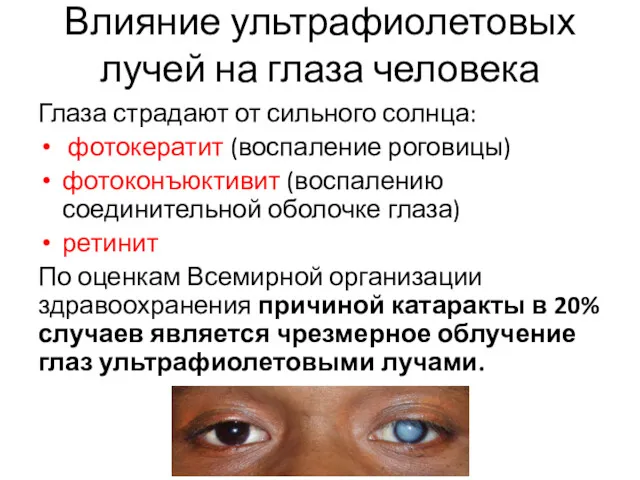 Влияние ультрафиолетовых лучей на глаза человека Глаза страдают от сильного