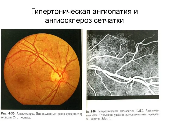 Гипертоническая ангиопатия и ангиосклероз сетчатки