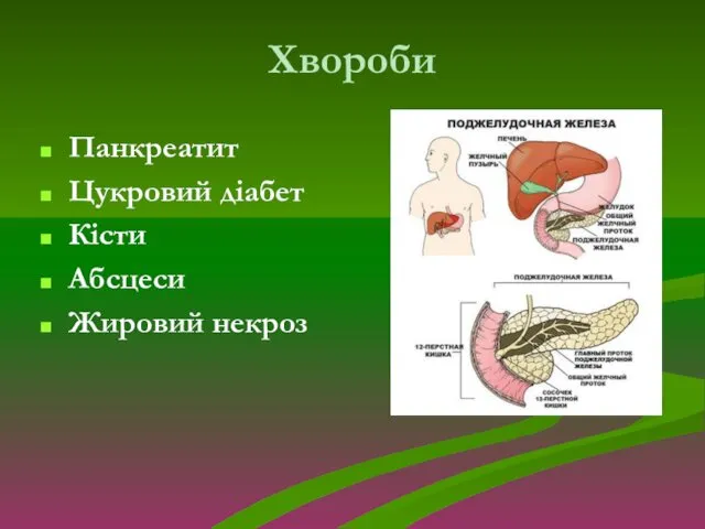 Хвороби Панкреатит Цукровий діабет Кісти Абсцеси Жировий некроз