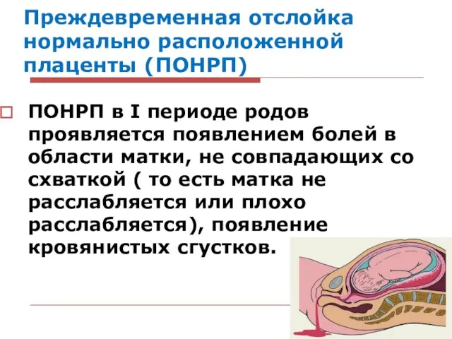 Преждевременная отслойка нормально расположенной плаценты (ПОНРП) ПОНРП в І периоде