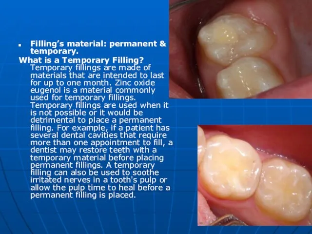 Filling’s material: permanent & temporary. What is a Temporary Filling? Temporary fillings are