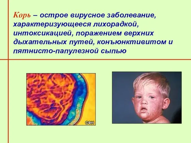 Корь – острое вирусное заболевание, характеризующееся лихорадкой, интоксикацией, поражением верхних дыхательных путей, конъюнктивитом и пятнисто-папулезной сыпью