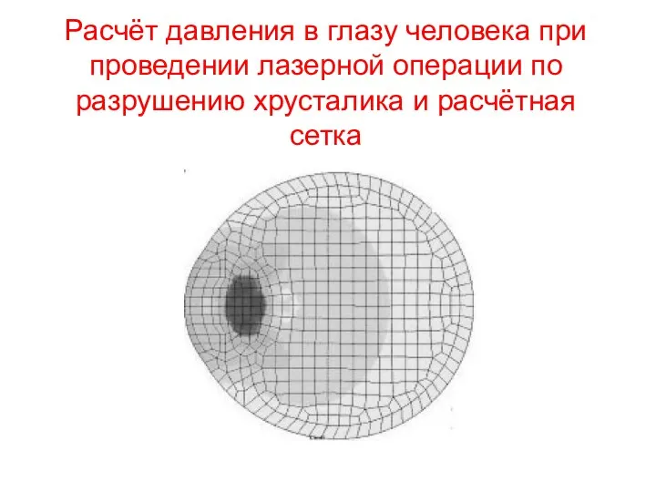 Расчёт давления в глазу человека при проведении лазерной операции по разрушению хрусталика и расчётная сетка
