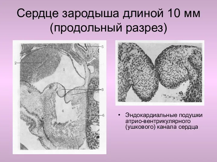 Сердце зародыша длиной 10 мм (продольный разрез) Эндокардиальные подушки атрио-вентрикулярного (ушкового) канала сердца