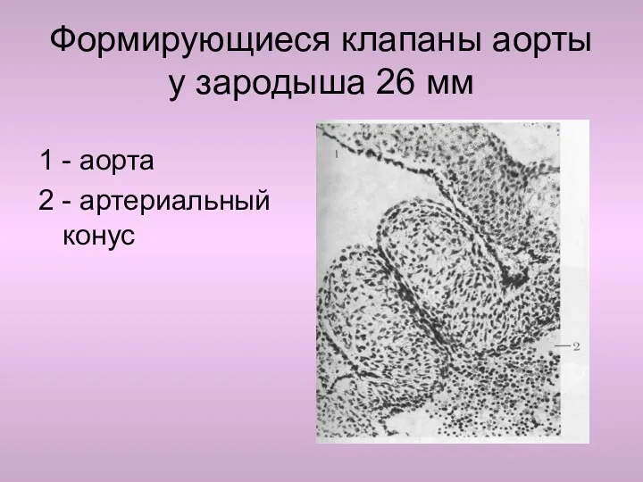 Формирующиеся клапаны аорты у зародыша 26 мм 1 - аорта 2 - артериальный конус