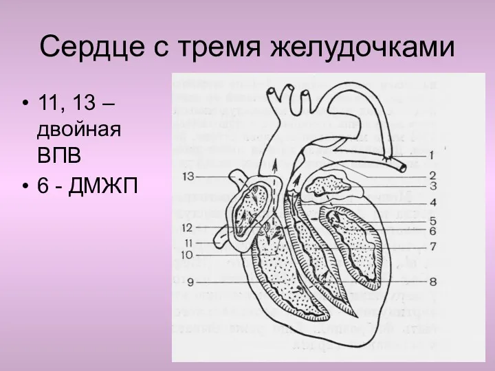 Сердце с тремя желудочками 11, 13 – двойная ВПВ 6 - ДМЖП