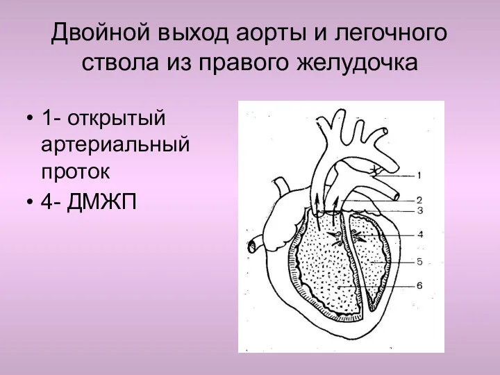 1- открытый артериальный проток 4- ДМЖП Двойной выход аорты и легочного ствола из правого желудочка