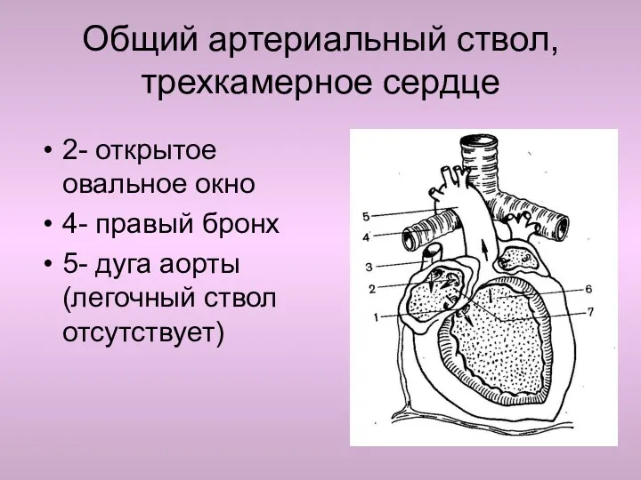 Общий артериальный ствол, трехкамерное сердце 2- открытое овальное окно 4-