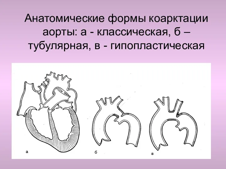 Анатомические формы коарктации аорты: а - классическая, б – тубулярная, в - гипопластическая