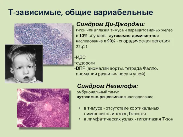 Т-зависимые, общие вариабельные Синдром Ди-Джорджи: гипо- или аплазия тимуса и
