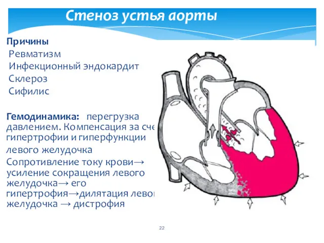 Стеноз устья аорты Причины Ревматизм Инфекционный эндокардит Склероз Сифилис Гемодинамика: