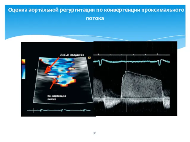 Оценка аортальной регургитации по конвергенции проксимального потока Конвергенция потока Левый желудочек