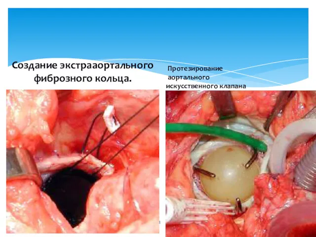 Протезирование аортального искусственного клапана Создание экстрааортального фиброзного кольца.