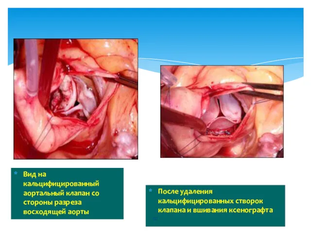 После удаления кальцифицированных створок клапана и вшивания ксенографта Вид на кальцифицированный аортальный клапан