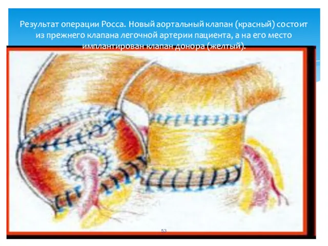 Результат операции Росса. Новый аортальный клапан (красный) состоит из прежнего клапана легочной артерии
