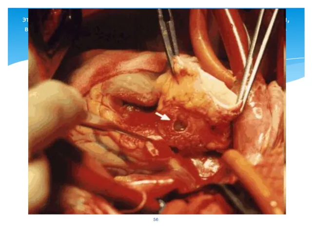 этап имплантации легочного аутографта, проксимальный анастомоз наложен, вшивается площадка с левой коронарной артерией