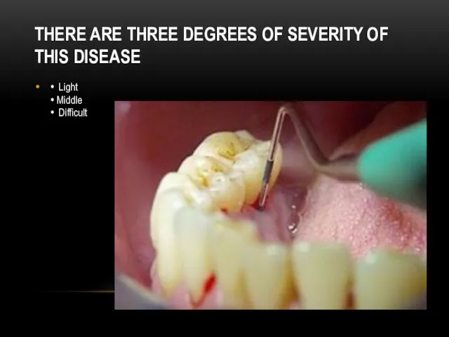 THERE ARE THREE DEGREES OF SEVERITY OF THIS DISEASE • Light • Middle • Difficult