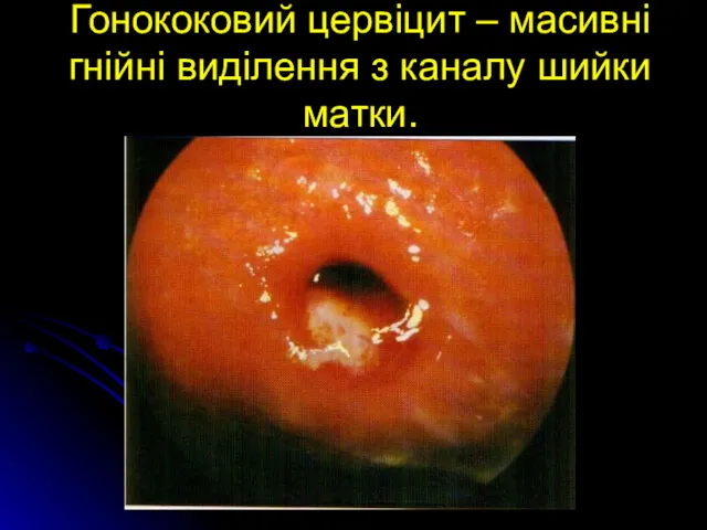 Гонококовий цервіцит – масивні гнійні виділення з каналу шийки матки.