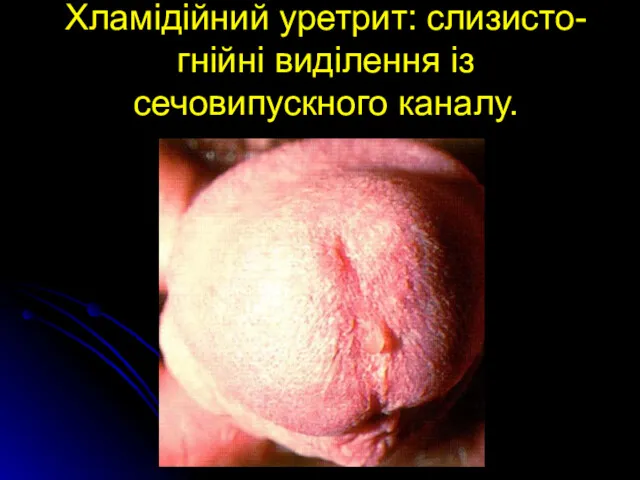 Хламідійний уретрит: слизисто-гнійні виділення із сечовипускного каналу.