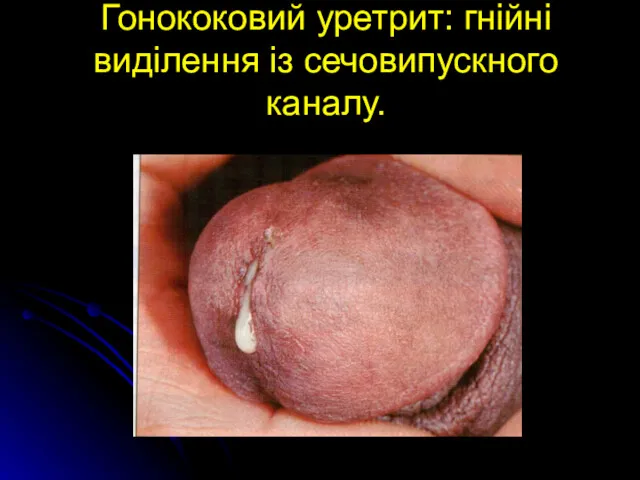 Гонококовий уретрит: гнійні виділення із сечовипускного каналу.