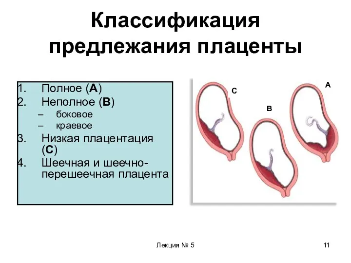 Лекция № 5 Классификация предлежания плаценты Полное (А) Неполное (В)