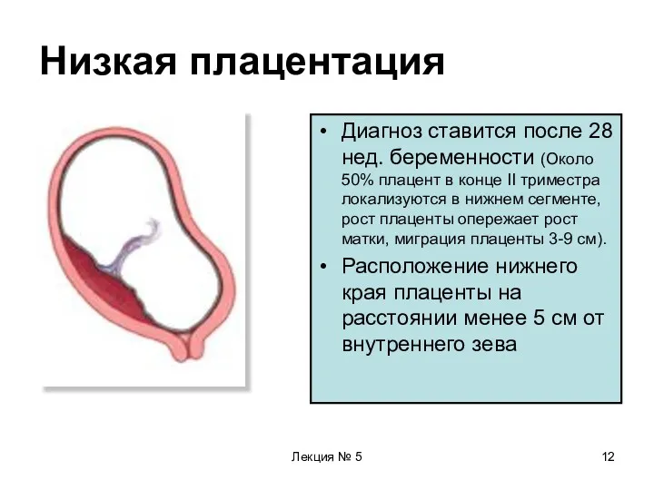 Лекция № 5 Низкая плацентация Диагноз ставится после 28 нед.