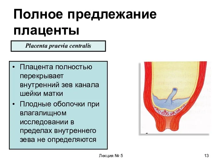 Лекция № 5 Полное предлежание плаценты Плацента полностью перекрывает внутренний