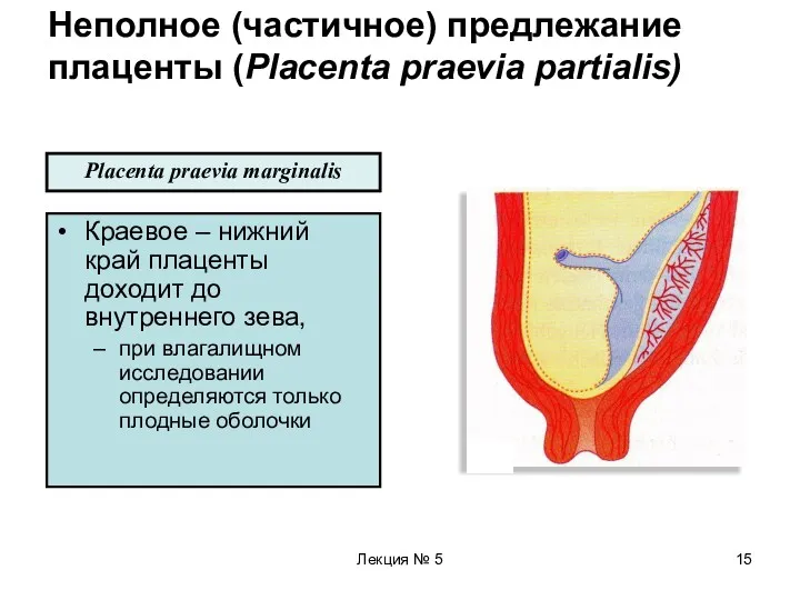 Лекция № 5 Неполное (частичное) предлежание плаценты (Placenta praevia partialis)