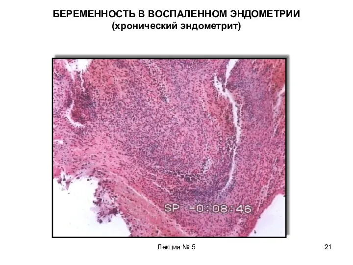 Лекция № 5 БЕРЕМЕННОСТЬ В ВОСПАЛЕННОМ ЭНДОМЕТРИИ (хронический эндометрит)