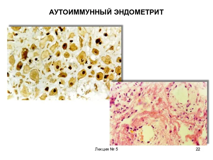 Лекция № 5 АУТОИММУННЫЙ ЭНДОМЕТРИТ