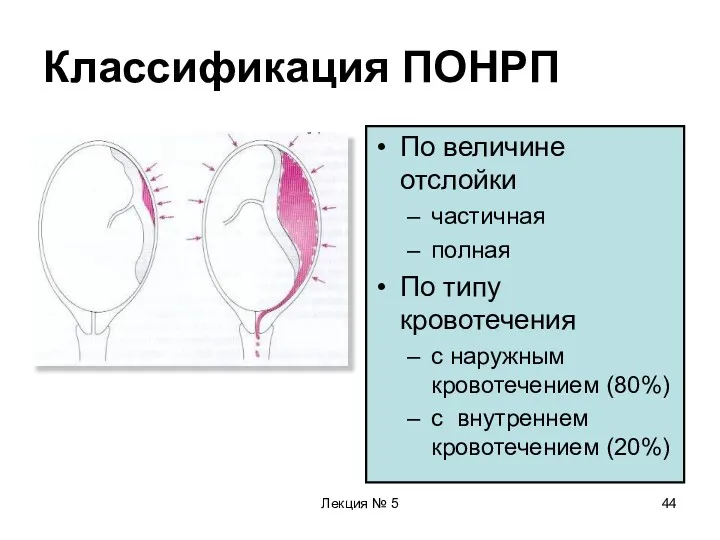 Лекция № 5 Классификация ПОНРП По величине отслойки частичная полная