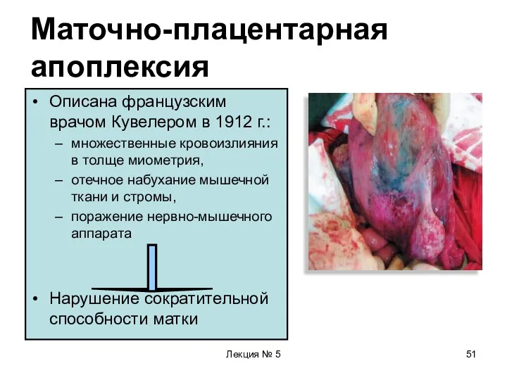 Лекция № 5 Маточно-плацентарная апоплексия Описана французским врачом Кувелером в