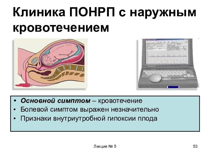 Лекция № 5 Клиника ПОНРП с наружным кровотечением Основной симптом