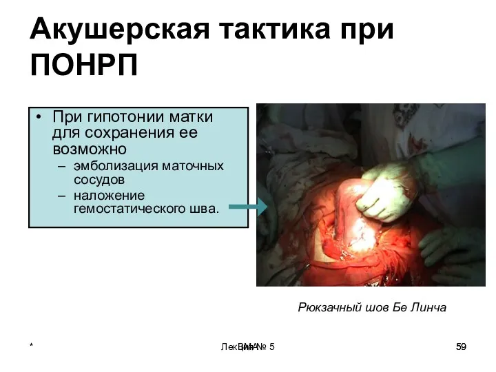 Лекция № 5 ВМА Акушерская тактика при ПОНРП При гипотонии