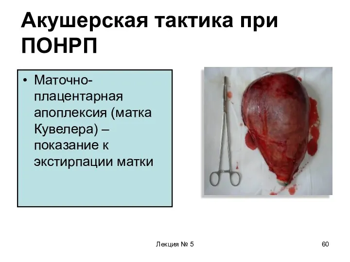 Лекция № 5 Акушерская тактика при ПОНРП Маточно-плацентарная апоплексия (матка Кувелера) – показание к экстирпации матки