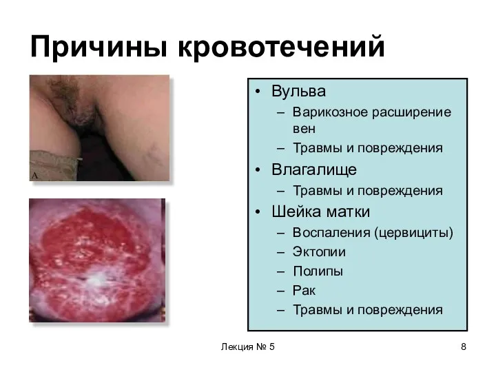 Лекция № 5 Причины кровотечений Вульва Варикозное расширение вен Травмы